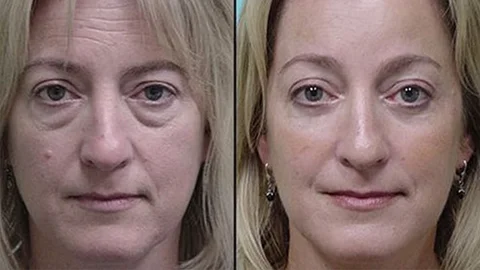 طريقة بسيطة لإزالة التجاعيد في 14 يوم من المنزل – بدون بوتوكس! طريقة بسيطة لإزالة التجاعيد في 14 يوم من المنزل – بدون بوتوكس!